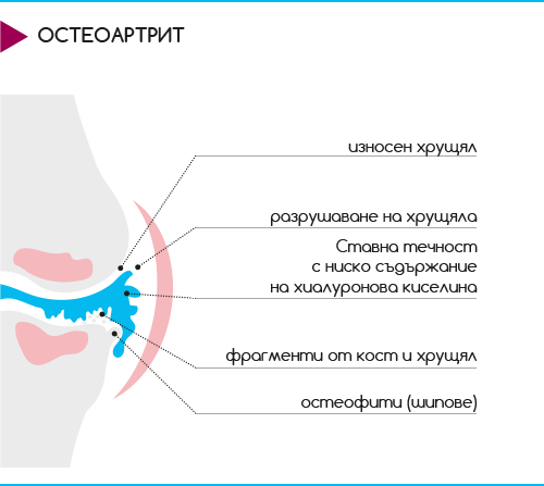Osteoarthritis